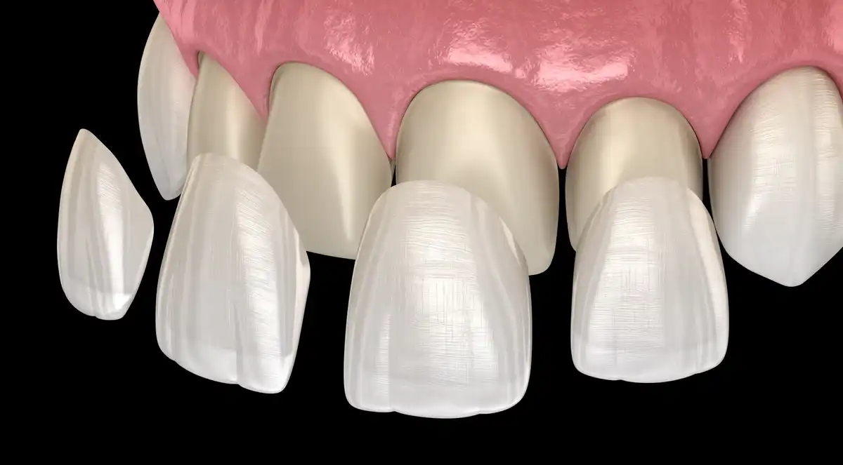 Dental Veneer