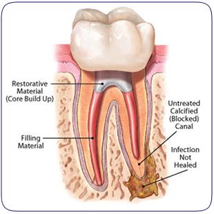Understanding the Realities of Root Canal Treatment Success