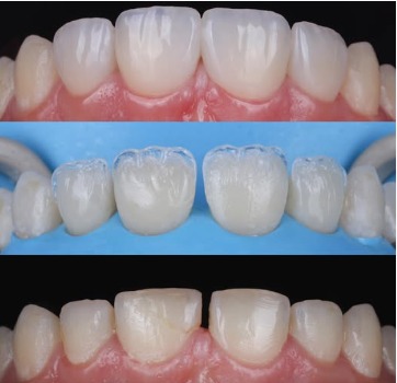 The Rise of Direct Composite Veneers in Modern Dentistry