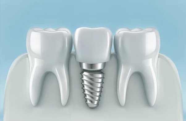 Are dental implants always the best option for every patient?                                                                                          